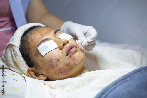 Acne extraction in a beauty clinic. Skin inflammation. The concept of beauty in women. Skin disorders lead to depression and insecurity in women.
