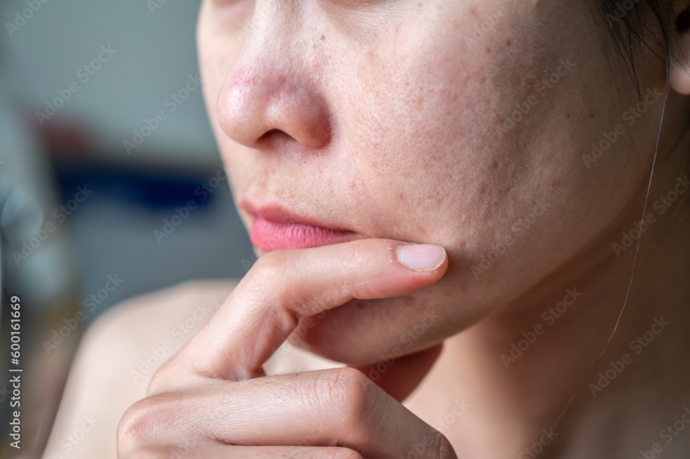 Obraz premium Cropped shot of worried Asian woman with skin problem such as acne, scar, wrinkled occur on her face. Allergies, irritants, genetic makeup, etc can cause skin conditions.