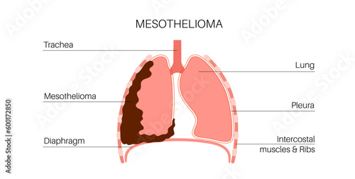 Mesothelioma cancer disease