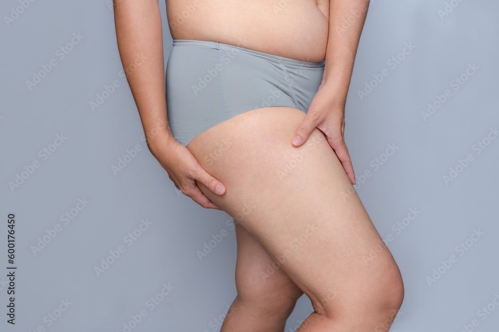 Close-up shot of a woman wearing underwear standing touching thighs, obesity treatment, cellulite on hips, buttocks, overweight, varicose veins Close-up shot of a woman wearing underwear standing touching thighs, obesity treatment, cellulite on hips, buttocks, overweight, varicose veins