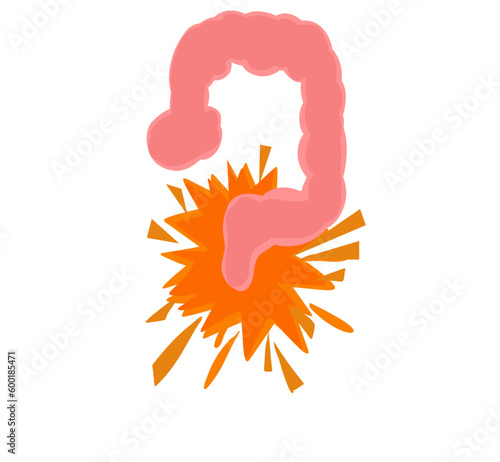 Ulcerative colitis concept. Inflammatory bowel disease. Ulcer and inflammation of the digestive tract, abdominal pain, colon problem in human body.