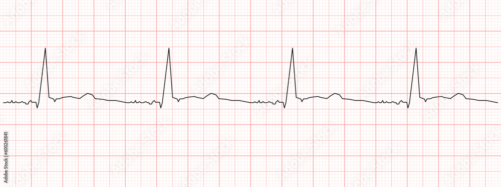 Black heart beat diagram on red graph paper. Electrocardiogram chart example. Cardiac rhythm line. Cardio test sign. Cardiology hospital symbol