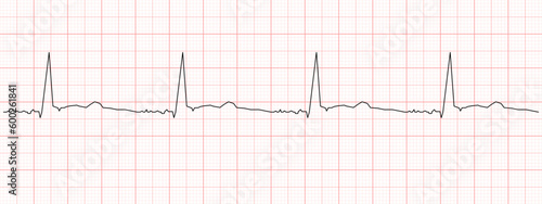 Black heart beat diagram on red graph paper. Electrocardiogram chart example. Cardiac rhythm line. Cardio test sign. Cardiology hospital symbol