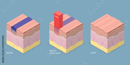 3D Isometric Flat Vector Conceptual Illustration of Laser Tattoo Removing, Cosmetic Dermatology