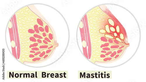 Normal breast and mastitis diagram; English language PNG