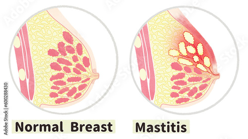 Normal breast and mastitis diagram; English language PNG photo