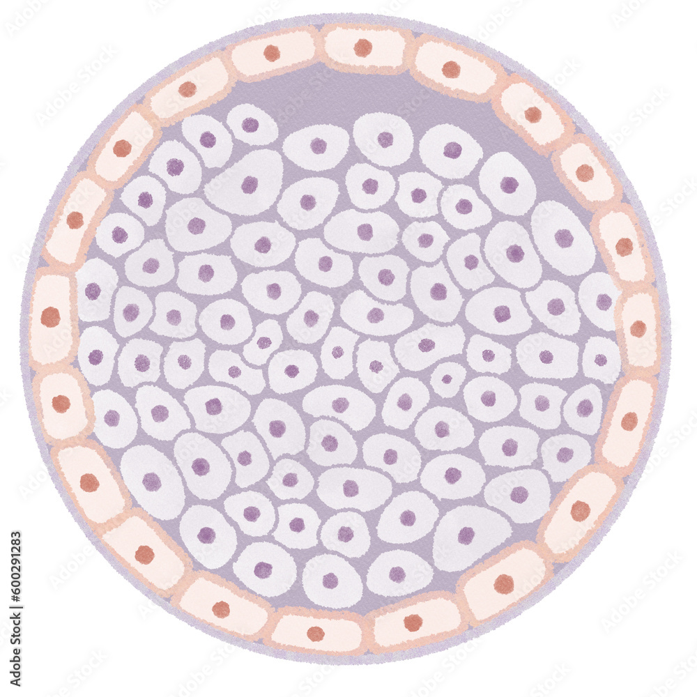 Ductal Carcinoma In Situ (DCIS) Breast cancer diagram PNG Ductal Carcinoma In Situ (DCIS) Breast cancer diagram PNG