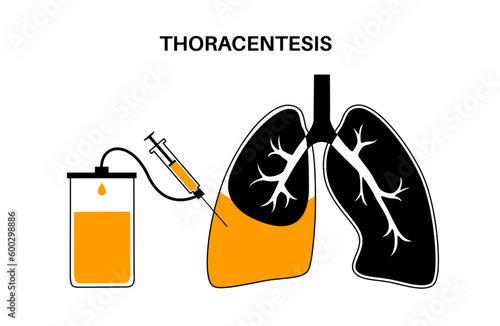 Thoracentesis medical procedure