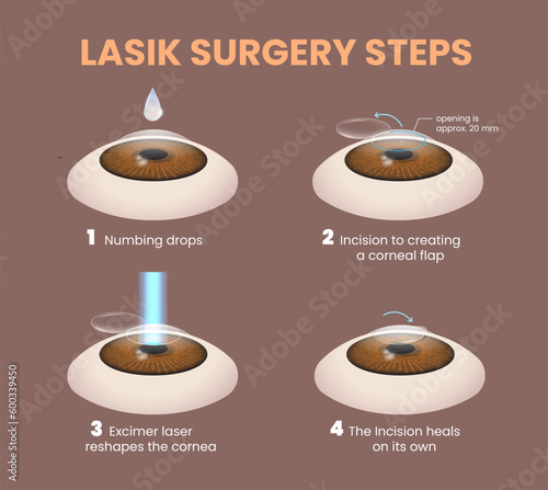 illustration of lasik eye surgery steps photo
