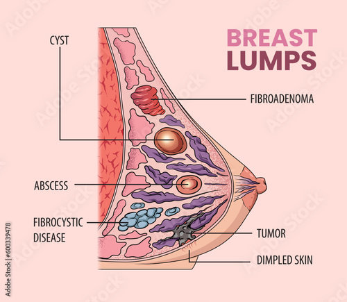 illustration of breast lumps types in women