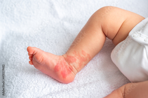 Hemangioma red birthmark on the leg of newborn baby photo