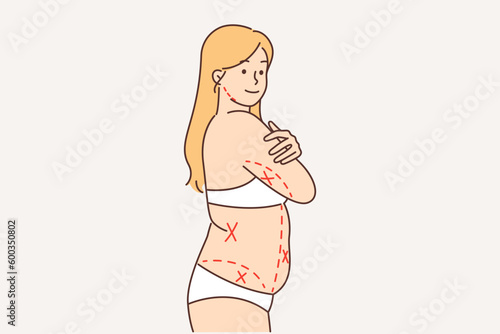 Fat woman without clothes with lines on body is preparing for liposuction or diet