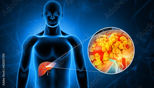 Liver damage such as Fatty liver, Fibrosis, Cirrhosis, and Liver cancer. 3d illustration