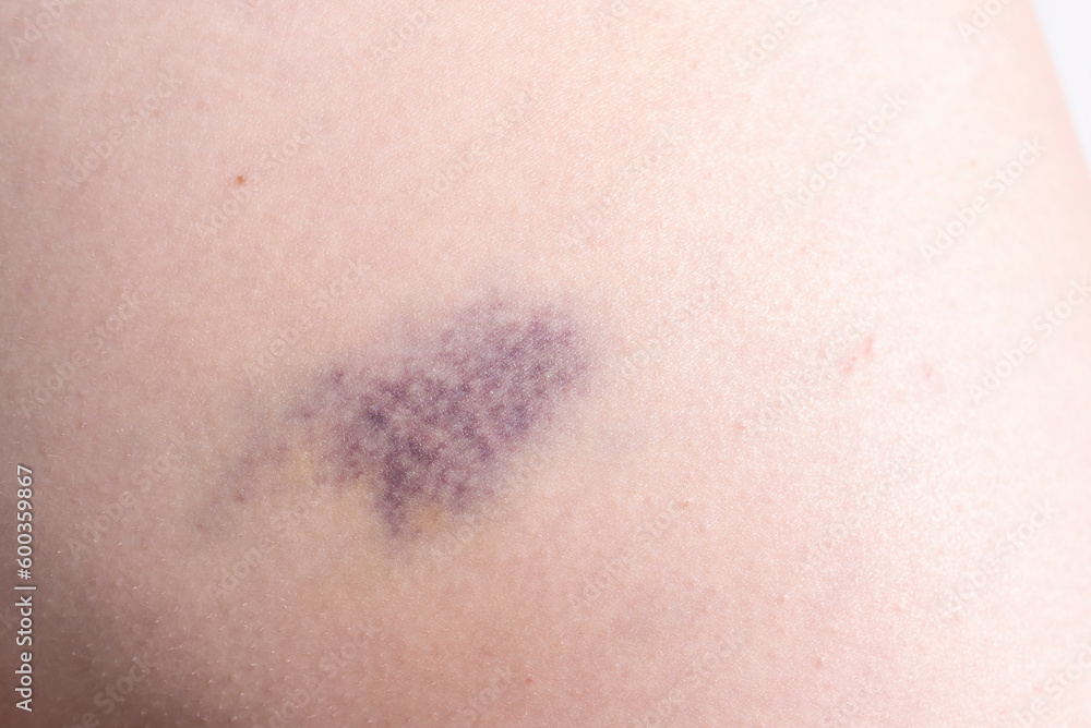 Closeup Blue Purple Hematoma, Bruise On Thigh, Hip After Trauma, Fall. Horizontal plane. Clotted Blood, Injury On Human Body Concept.