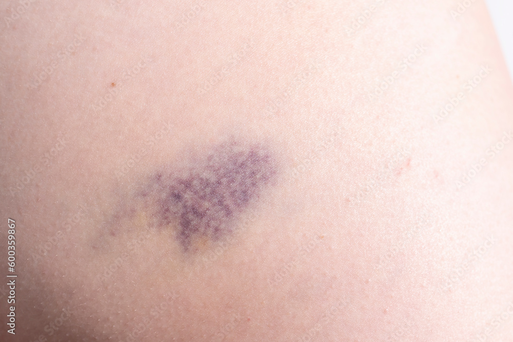 Closeup Blue Purple Hematoma, Bruise On Thigh, Hip After Trauma, Fall. Horizontal plane. Clotted Blood, Injury On Human Body Concept. Closeup Blue Purple Hematoma, Bruise On Thigh, Hip After Trauma, Fall. Horizontal plane. Clotted Blood, Injury On Human Body Concept.