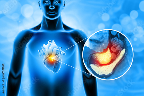 Photography Cholesterol blocked artery with heart. 3d illustration