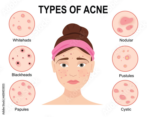 Types of acne with woman isolated on white background. Skin problems. Beauty concept. Vector illustration
