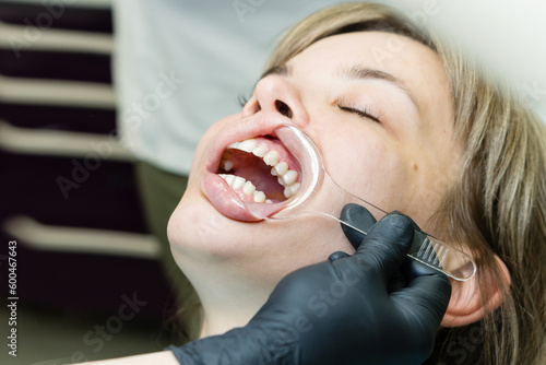 Checkup at dentist. Retractor in patient's mouth photo