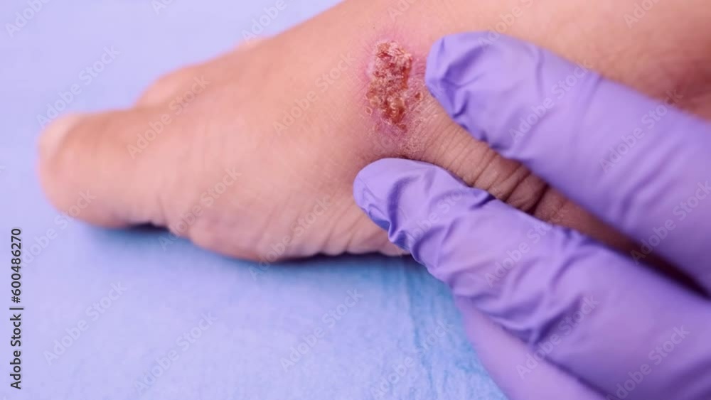 doctor treats weeping wound, trophic ulcer on female leg, wound exudate prevents healing ulcers