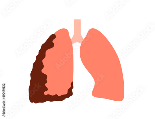 Mesothelioma cancer disease
