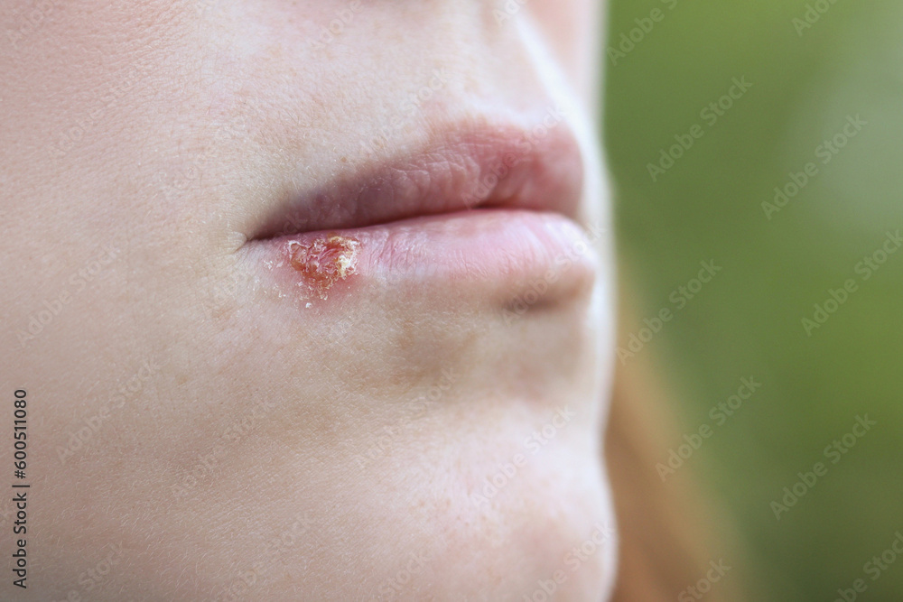 Fotografia do Stock Close up girl's lips affected by herpes. Treatment
