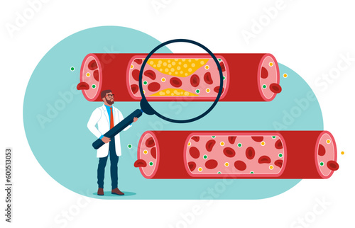 Doctor studying blood vessels and veins from cholesterol and blood cells clot. Cardiovascular system, cardiology, medical examination topics. Heart disease research. Flat vector illustration photo