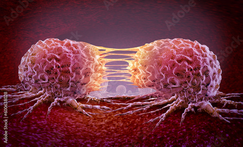 Tableau sur toile Metastasis Cancer cell and oncology or Malignant Cancerous Growth as growing div