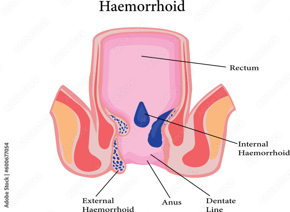Rectate Clot Cross section of the rectum and anal canal. illustration of hemorrhoids ...