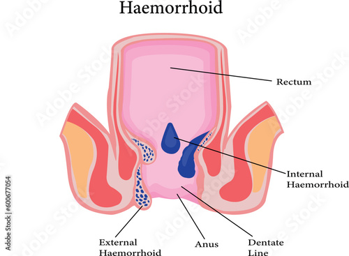 Cross section of the rectum and anal canal. illustration of hemorrhoids structure
