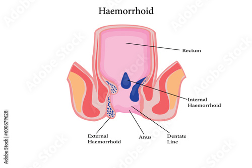 Cross section of the rectum and anal canal. illustration of hemorrhoids structure. vector eps 10 photo