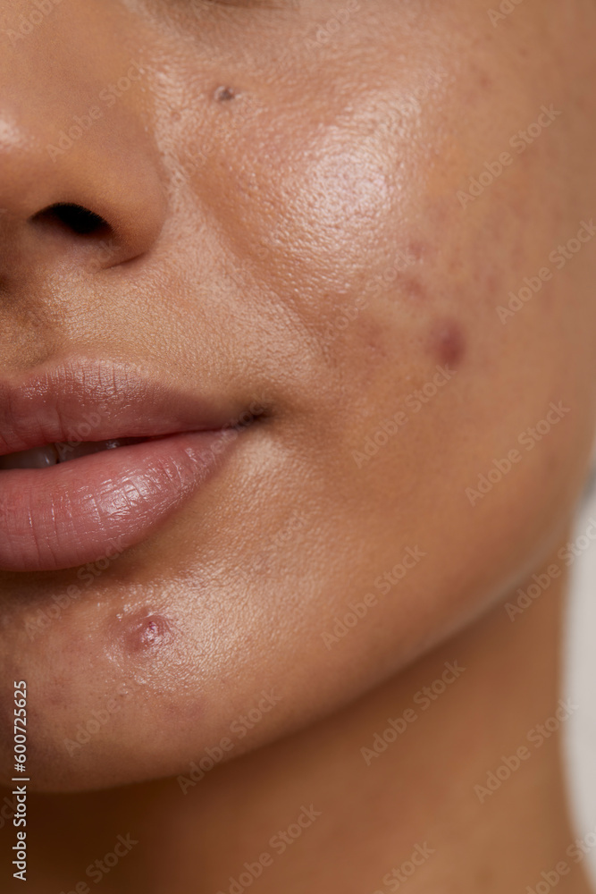 Obraz premium Close-up of woman face with acne