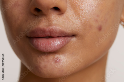 Close-up of woman face with acne photo
