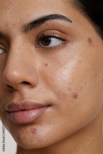 Close-up of woman face with acne photo