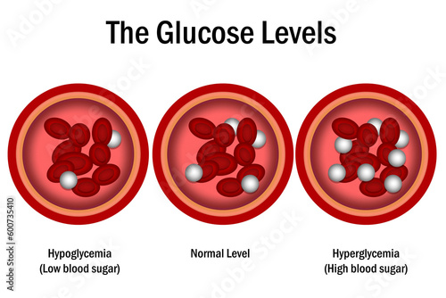 Blood Glucose Levels. normal level, hyperglycemia and hypoglycemia