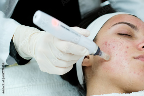 Closeup view of woman having microneedling procedure applied on her face. Microneedling. Dermapen. Esthetician. Health and beauty.  photo