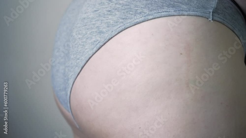 Thigh of a woman with cellulite. Figure problem, cosmetic massage. An overweight girl massages her leg with her hands and checks for cellulite. photo