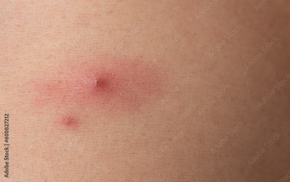 Fototapeta premium Black dots on face and pimples,close up of acne