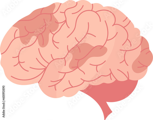 Cerebrovascular Brain Disease