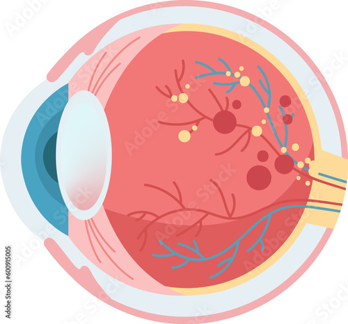 Eye Damage Disease