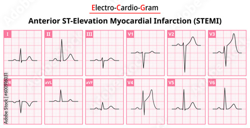 Anterior STEMI (ST-Elevation Myocardial Infarction) - The Differences in ECG Waveform for Each of the 12 Leads - Vectors and Illustrations for Medical Purposes