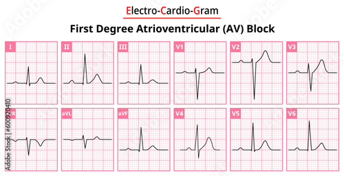 First Degree AV (Atrioventricular) Block - The Differences in ECG Waveform for Each of the 12 Leads - Vectors and Illustrations for Medical Purposes