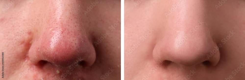 Fototapeta premium Photos of man before and after acne treatment, closeup. Collage showing affected and healthy skin