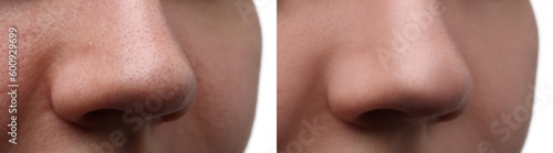 Before and after acne treatment. Photos of woman on white background  closeup. Collage showing affected and healthy skin