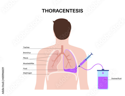 Thoracentesis medical procedure