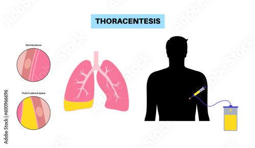 Thoracentesis medical procedure