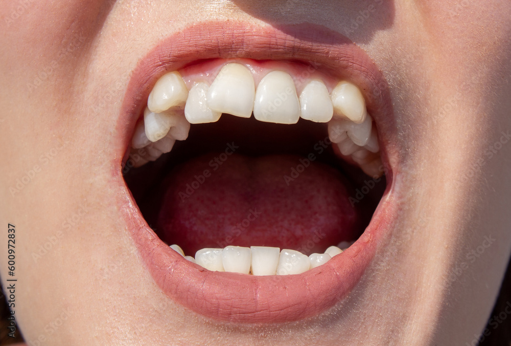 Obraz premium Curved female teeth, before installing braces. Close - up of teeth before treatment by an orthodontist