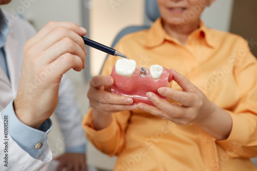 Closeup of unrecognizable dentist pointing at tooth model while explaining dental implant surgery to patient in clinic photo