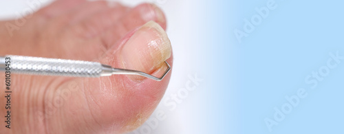 dermatologist, dermatovenereologist, podologist treats damaged rude nail on big toe of female foot, exfoliation, nail fungus, treatment Nail onycholysis, Paramedical, Medical pedicure, aging problems