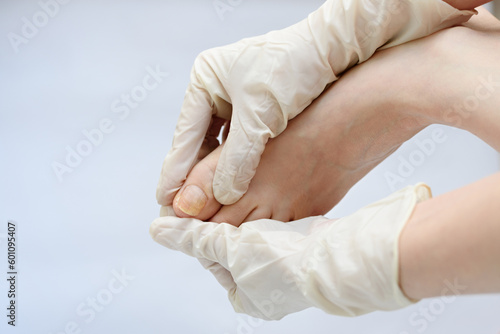Onychomycosis. Foots with fungus on nails is examined by doctor in gloves © Viktoryia