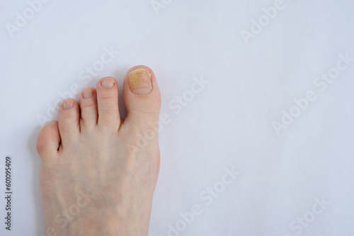 Toenails affected by fungal infection. Onychomycosis photo